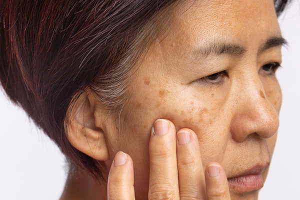 close-up photo of a middle-aged woman with spots on her face indicative of melasma, looking concerned and holding her hand to her cheek
